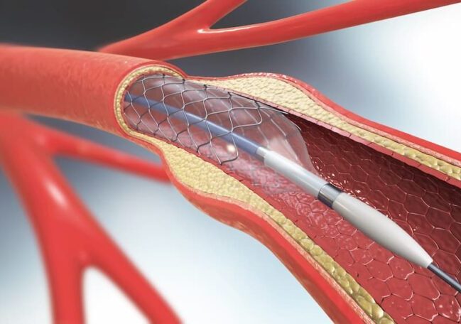 3d illustration of stent implantation for supporting blood circulation into blood vessels